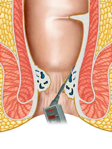 hemorrhoid-ultroid.jpg